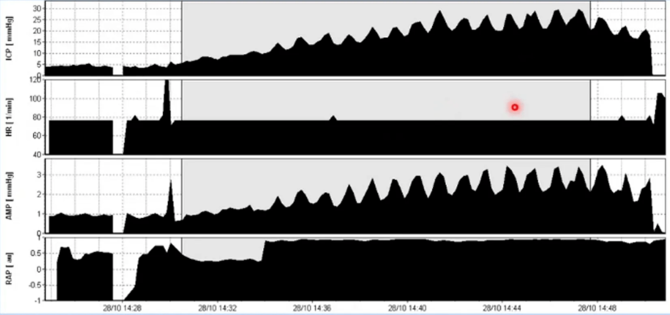 Normal baseline pressure with increased resistance to CSF outflow. Strong regular vasogenic waves recorded during the study. Overall: disturbed CSF dynamics.