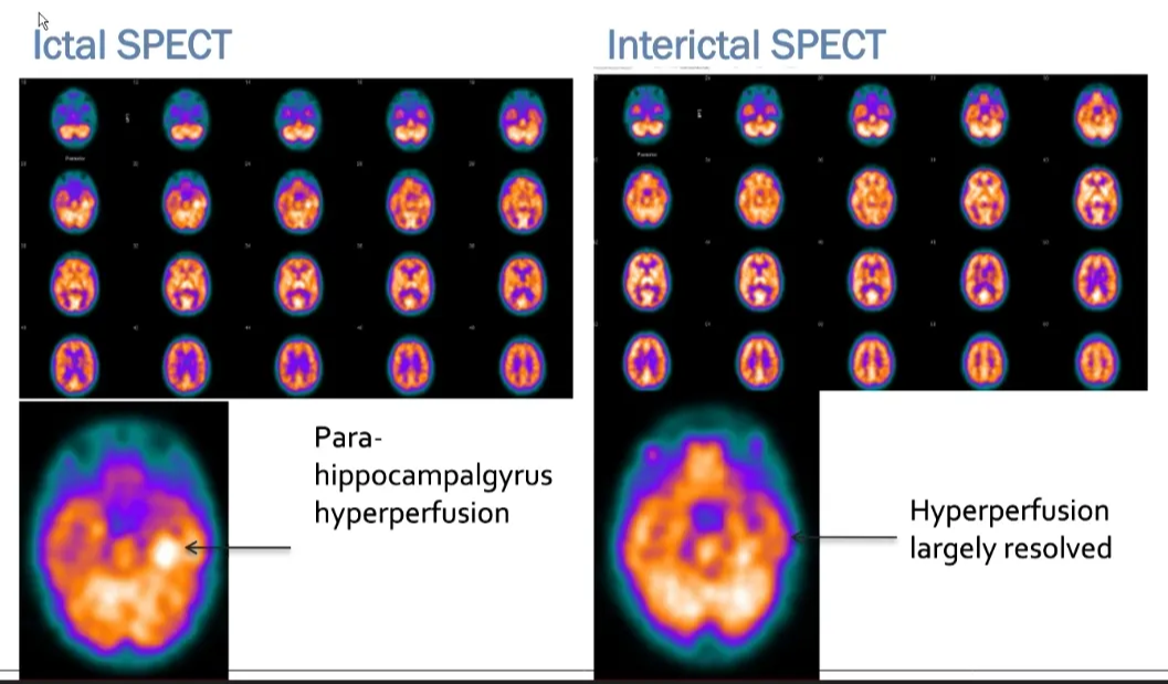 ⁹⁹mTc-HMPAO brain perfusion SPECT