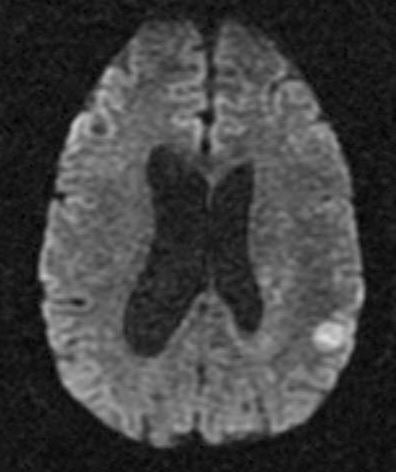 T2 shine through DWI