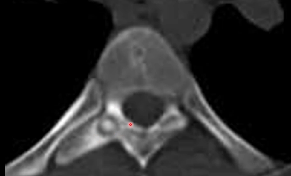 Osteoid osteoma