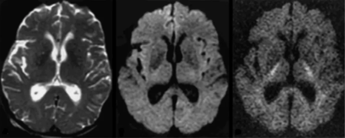 Brain DWI images using 3 different b-values (0, 1000, and 3000 s/mm²)