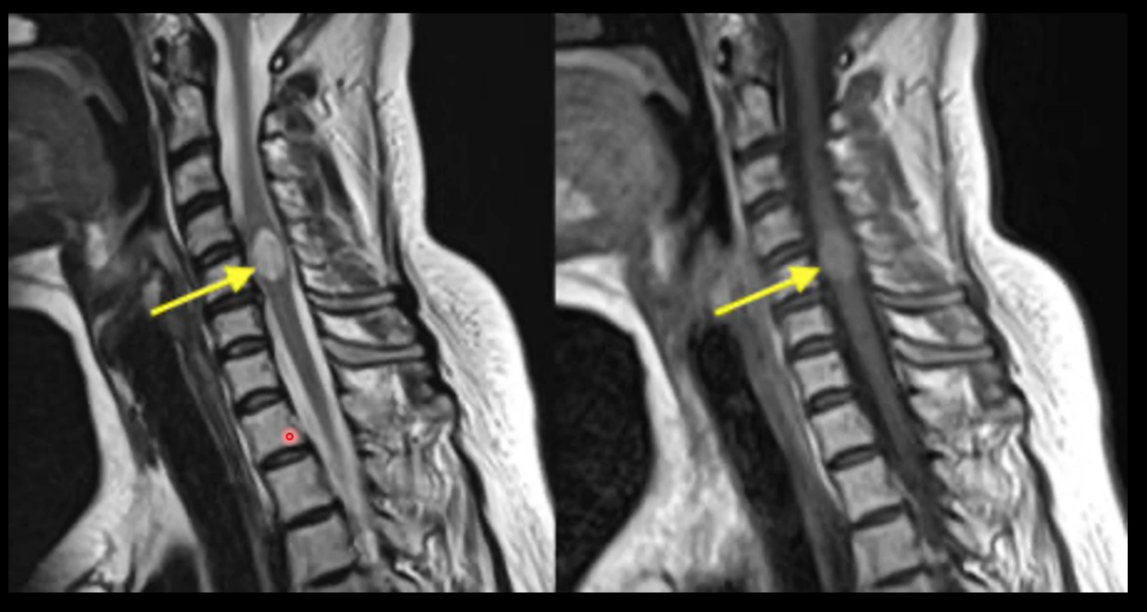Spinal cord met
