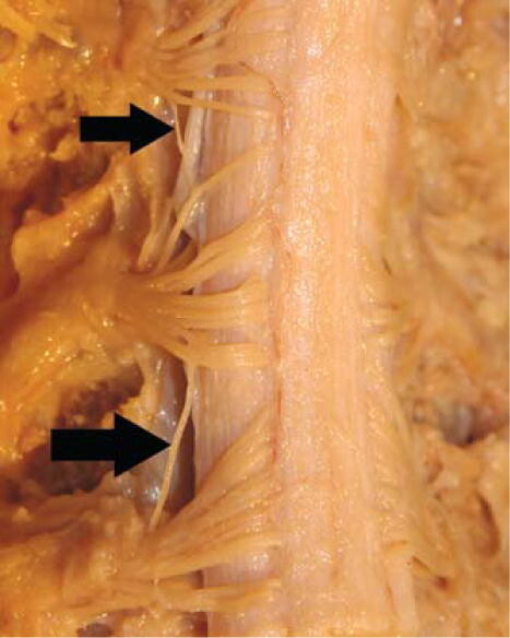 Showing interconnections between the dorsal roots of C-4 and C-5 (upper arrow) and C-5 and C-6 (lower arrow), both on the left side.