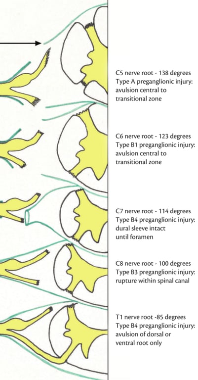 C5 nerve root - 138 degrees Type A preganglionic injury. avulsion central to transitional zone C6 nerve root - 123 degrees Type Bl preganglionic injury: avulsion central to transitional zone C7 nerve root - 114 degrees Type B4 preganglionic injury: dural sleeve intact until foramen C8 nerve root - 100 degrees Type B3 preganglionic injury: rupture within spinal canal Tl nerve root -85 degrees Type B4 preganglionic injury: avulsion of dorsal or ventral root only 