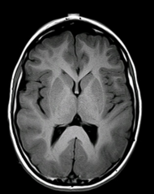 Grey matter is hypointense