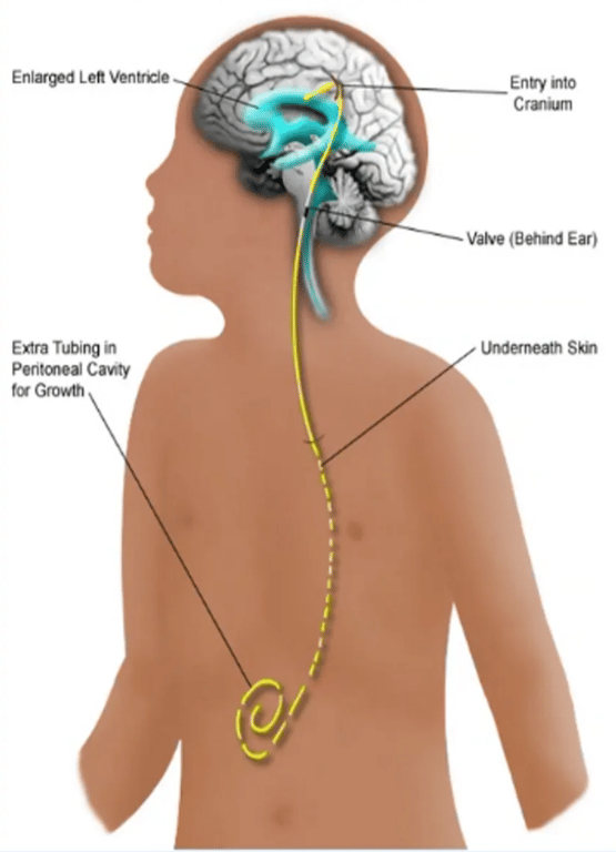 Ventriculoperitoneal shunt placement