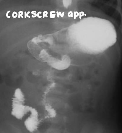 Corkscrew appearance