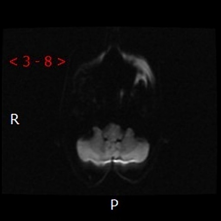 A close-up of a scan of a brain AI-generated content may be incorrect.