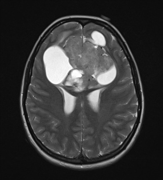 A close-up of a brain scan AI-generated content may be incorrect.