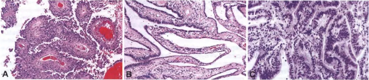 Fig. 3.12 Papillary ependymoma. A Discohesive growth, pseudopapillae, and perivascular pseudorosettes. B Finger-like projections lined by single or multiple layers of cuboidal tumour cells with smooth contiguous surfaces. C This ependymoma variant is characterized by well-formed papillae in which a central vessel is covered by layers of tumour cells. The differential diagnosis includes choroid plexus papilloma, the rare papillary meningioma, and metastatic carcinoma. 