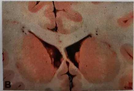 Fig. 2.16 Subependymal giant cell astrocytoma. A Coronal section of the left hemisphere of a patient with tuberous sclerosis, showing a subependymal giant cell astrocytoma (arrowheads) and multiple cortical tubers (arrows). B Multiple subependymal nodules on the walls of the lateral ventricles. 