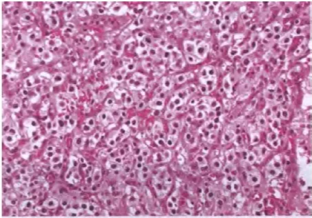 Fig. 3.13 Clear cell ependymoma, characterized by a relatively high cell density without significant increase In proliferation. Note the clear perinuclear cytoplasm resembling tumour cells in an oligodendroglioma. 
