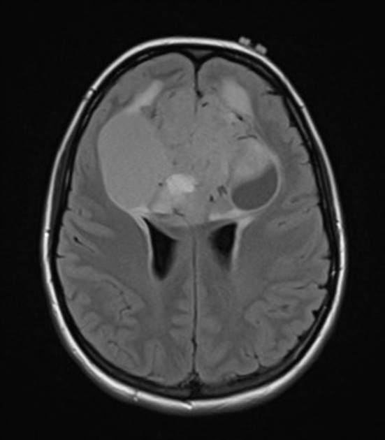 A close-up of a brain scan AI-generated content may be incorrect.