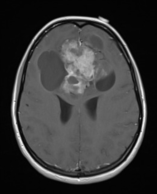 A close-up of a brain scan AI-generated content may be incorrect.