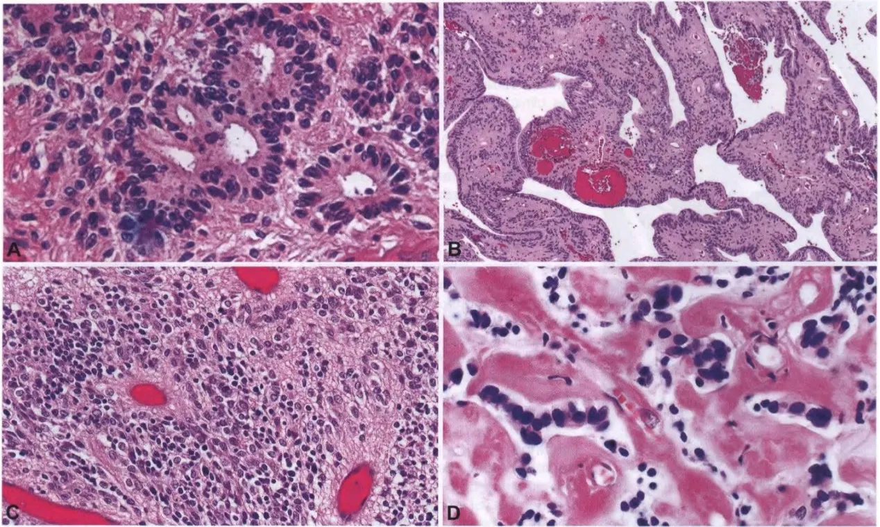 Fig. 3.10 Ependymoma. A Ependymal rosettes are characterized by columnar tumour cells arranged around a central lumen; they are infrequent, but a diagnostic hallmark of ependymoma {1291}. B Ependymal canals. C High tumour-cell density and perivascular pseudorosettes. D This ependymoma shows extensive hyalinization, which may precede calcification {1291 