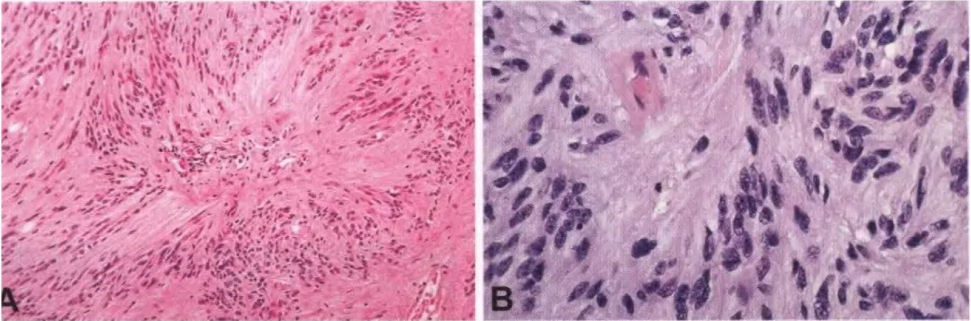 Fig. 3.14 Tanycytic ependymoma. A Bipolar spindle cells with elongated processes arranged around a central vessel. B Nuclei exhibit the typical salt-and-pepper speckling of ependymomas. 