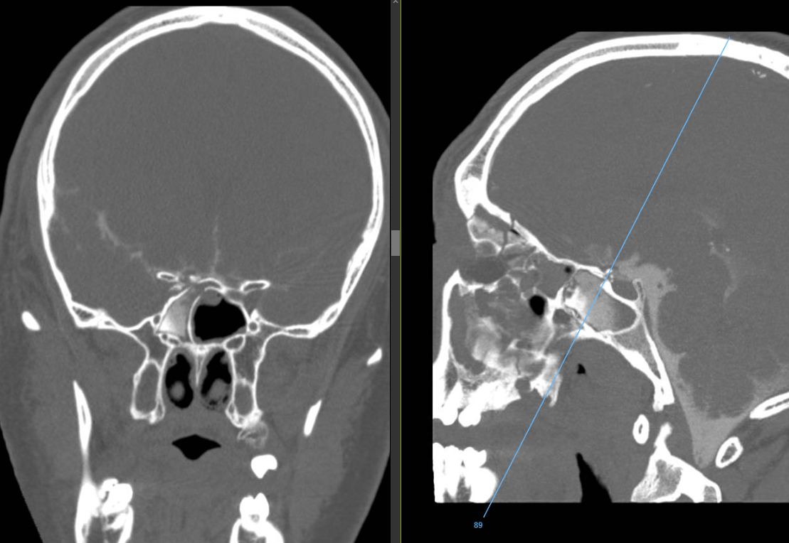 Young male with a 20-foot fall from tree with an extensive right facial fracture complex including R orbital roof and floor, R cribriform plate, R lamina papyracea, R zygomatic arch, sphenoid wing, lateral wall of maxillary sinus was found to have a CSF leak originating from the planum fracture as proven on a cisternogram demonstrating dense contrast accumulation in R sphenoid sinus. 