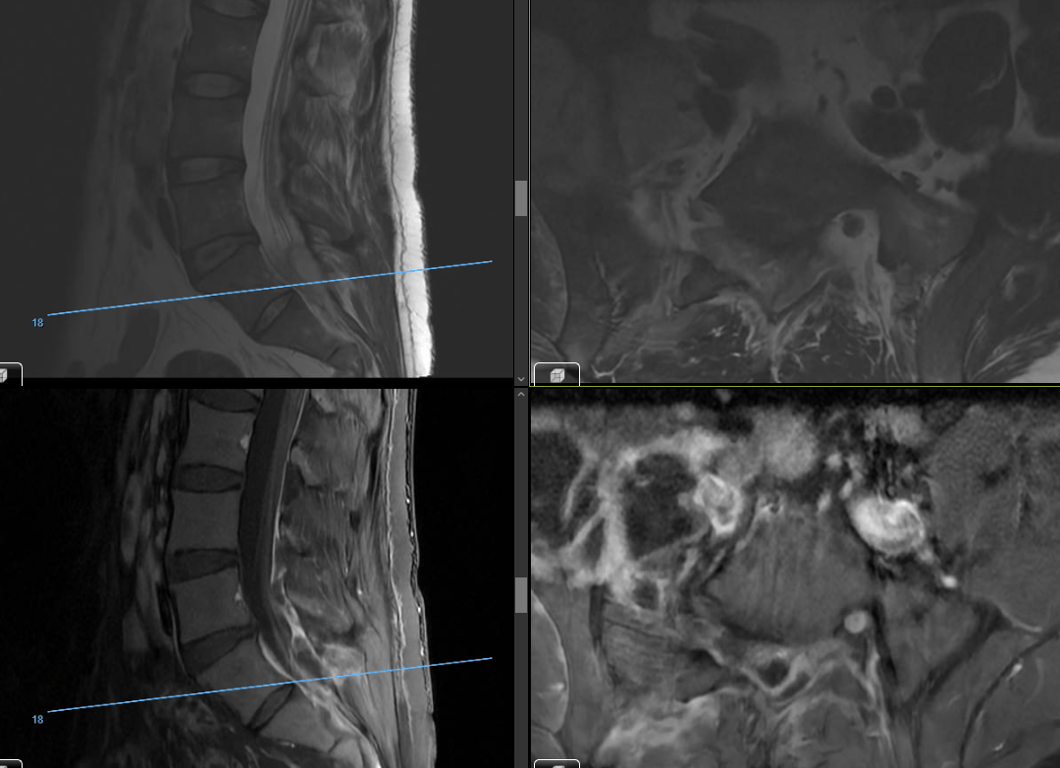 Sagittal T2 (upper left), axial T1 with contrast (upper right), sagittal T1 (lower left), sagittal T1+c (right lower) demonstrating a compressive lumbar epidural abscess at L5-S1.  