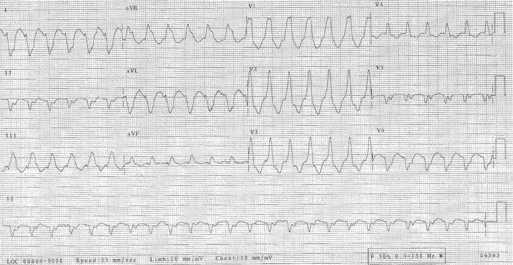 ECG image: LITFL ECG Library (litfl.com)