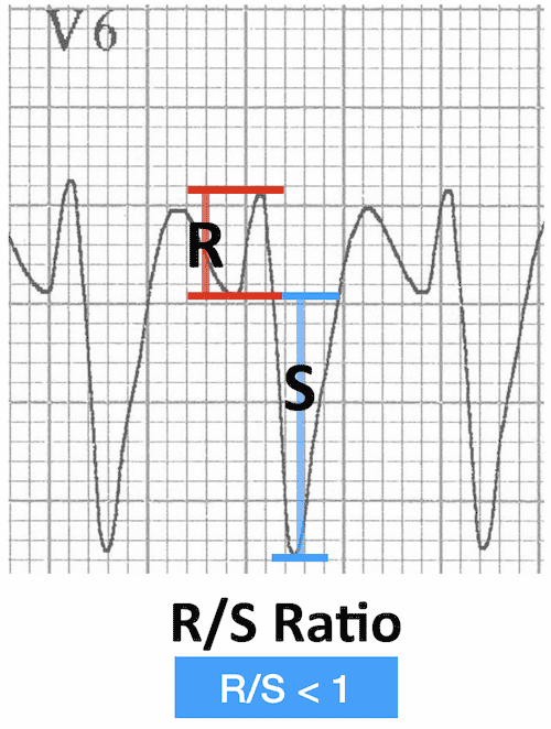 ECG image: LITFL ECG Library (litfl.com)