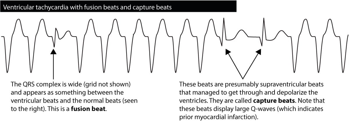 ECG image: LITFL ECG Library (litfl.com)