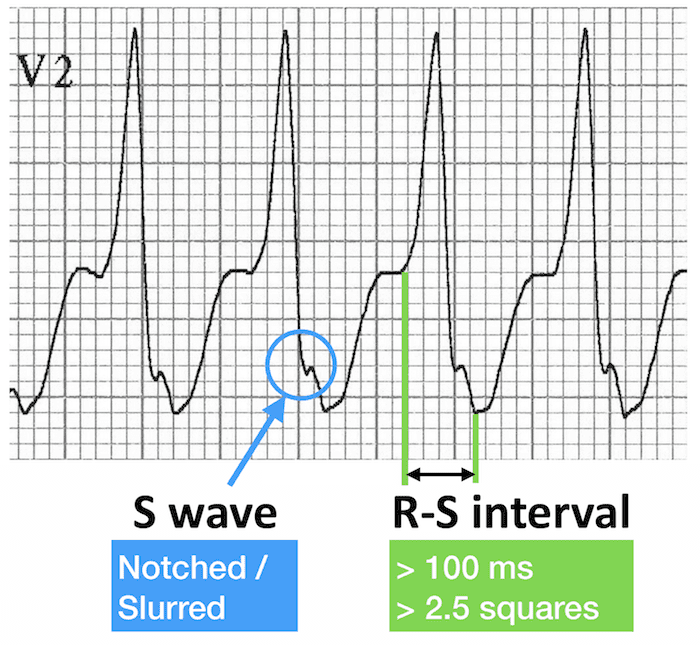ECG image: LITFL ECG Library (litfl.com)