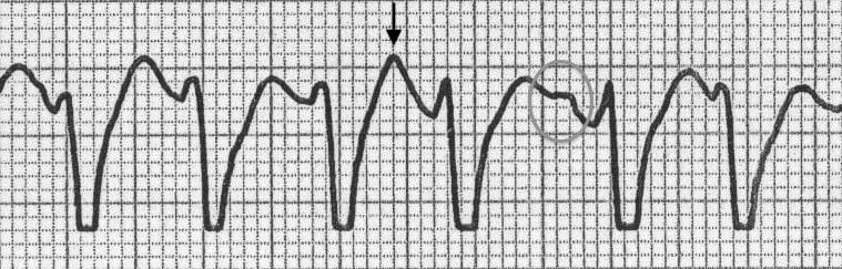 ECG image: LITFL ECG Library (litfl.com)