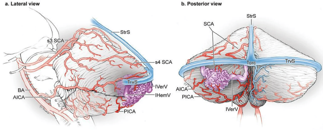 The suboccipital cerebellar AVM: (a) lateral and (b) posterior views. This AVM is based unilaterally on the suboccipital surface, can be supplied by all three cerebellar arteries, and has superficial, ascending venous drainage to the torcula and transverse sinuses. 