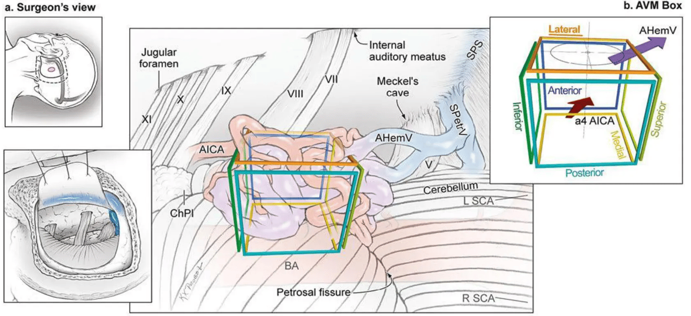 Resection strategy for petrosal cerebellar AVMs. (a) Step 1, exposing the AVM with an extended retrosigmoid craniotomy that includes limited mastoidectomy and skeletonization of the sigmoid sinus [surgeon’s view, which scalp incision (dashed line), craniotomy (solid line), and AVM (purple circle) shown on upper inset, and dural flap mobilizing the skeletonized SigmS anteriorly shown on lower inset). (b) AVM box showing arterial inputs from cortical branches of the AICA and drainage by anterior hemispheric veins, the vein of the cerebellopontine fissure, and the petrosal vein.