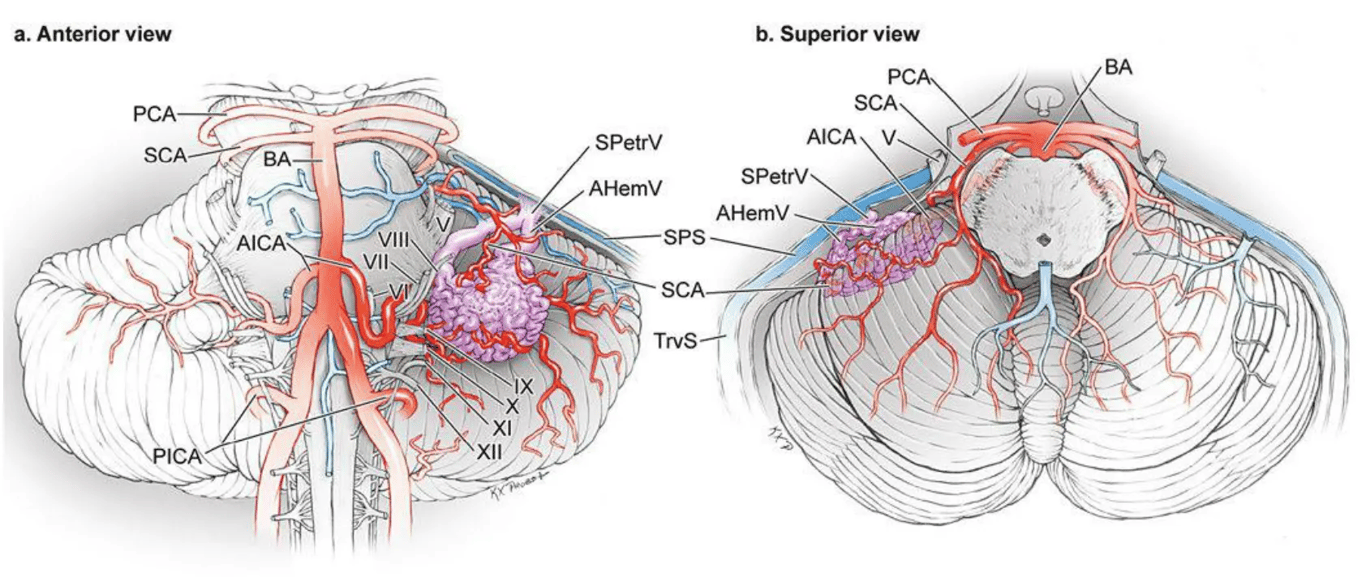 The petrosal cerebellar AVM: (a) superior and (b) anterior views. This AVM is based on the petrosal surface lateral to the brachium pontis. It is supplied by cortical branches of the AICA and is drained by the anterior hemispheric veins and petrosal vein.