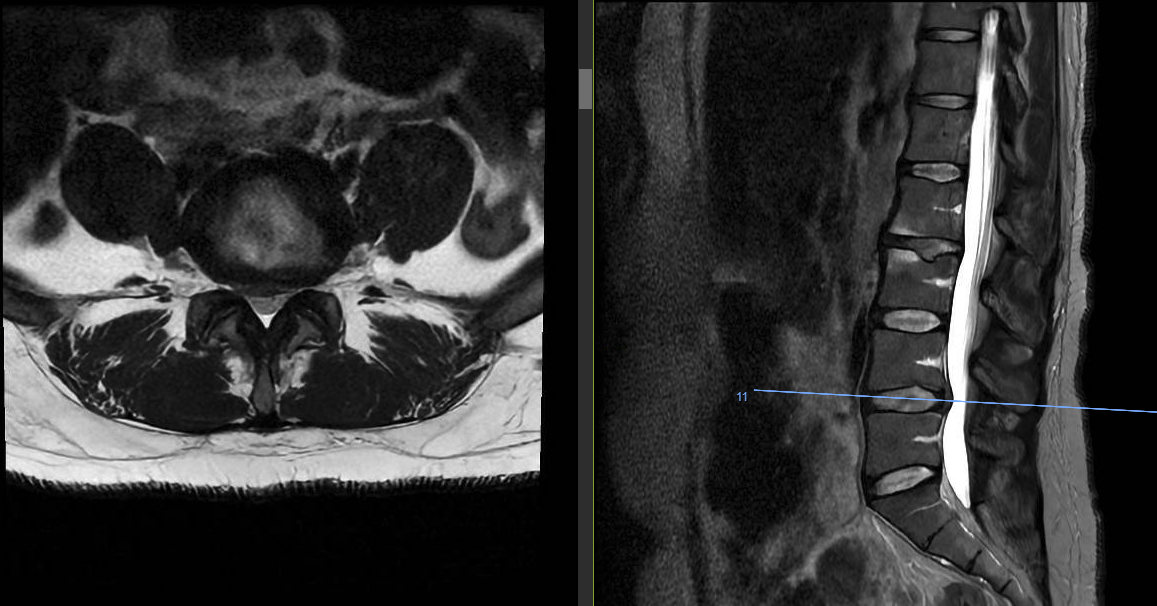 A 40 year old female with an L4-5 central disc protrusion with flavum thickening and facet hypertrophy resulting in severe canal and lateral recess stenosis. This patient had midline LBP with 