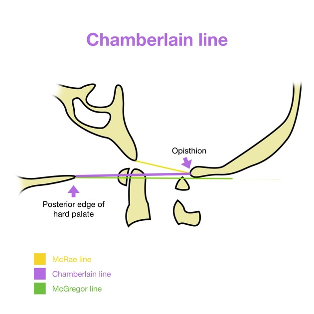 Chamberlain / McRae / McGregor lines: source https://radiopaedia.org/articles/chamberlain-line