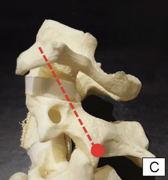 Transarticular screw