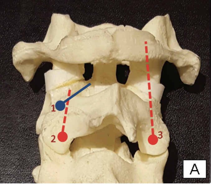 1. Pedicle screw
2. Pars screw
3. Transarticular screw