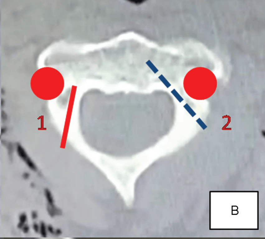 1. Pars screw
2. Pedicle screw