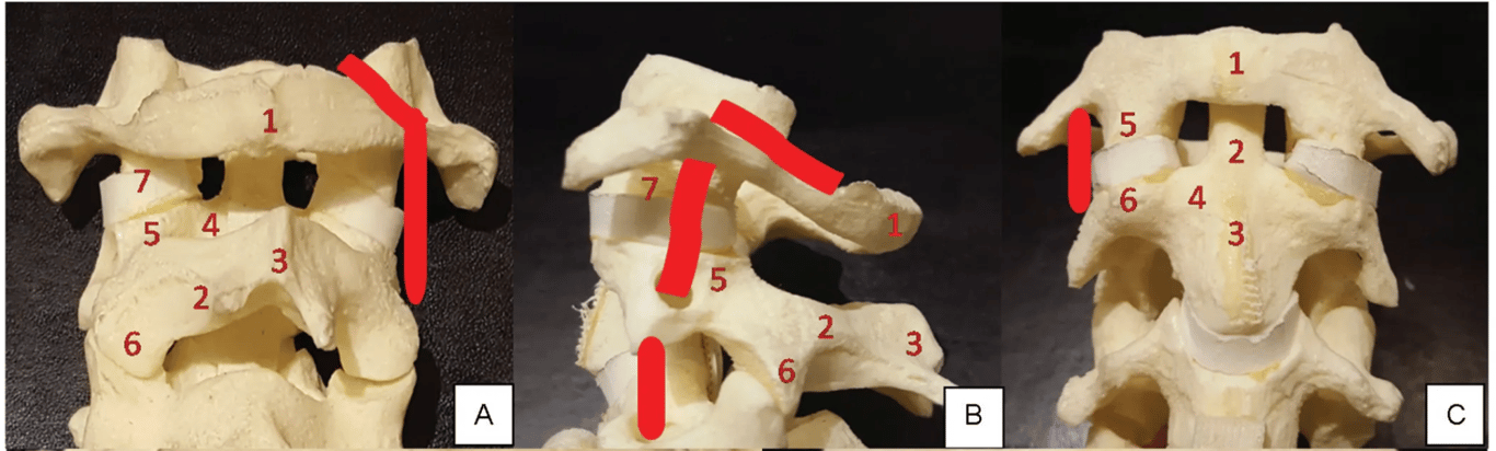 (A) Posterior view of C1–2-3. 
(B) Lateral View of C1–2-3.
(C) Anterior View of C1–2-3. 