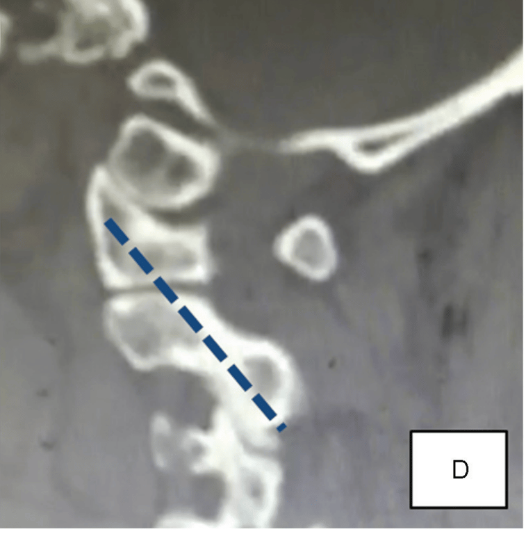 Transarticular screw