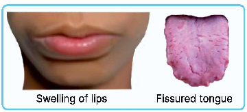 Melkerson-Rosenthal syndrome