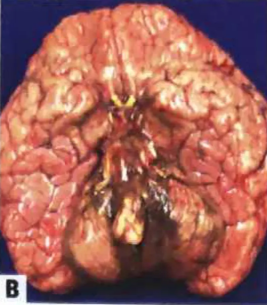 Meningeal melanomatosis. 
B Macroscopy of meningeal melanomatosis in a child with neurocutaneous melanosis who succumbed at the age of 17 months due to rapid disease progression.