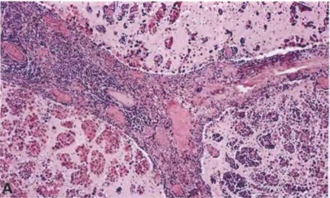 Fig. 12.02 Meningeal melanomatosis. A Extensive invasion of the subarachnoid space with perivascular infiltration of cerebral cortex. B Highly pleomorphic melanin-laden cells invading the cerebral cortex 