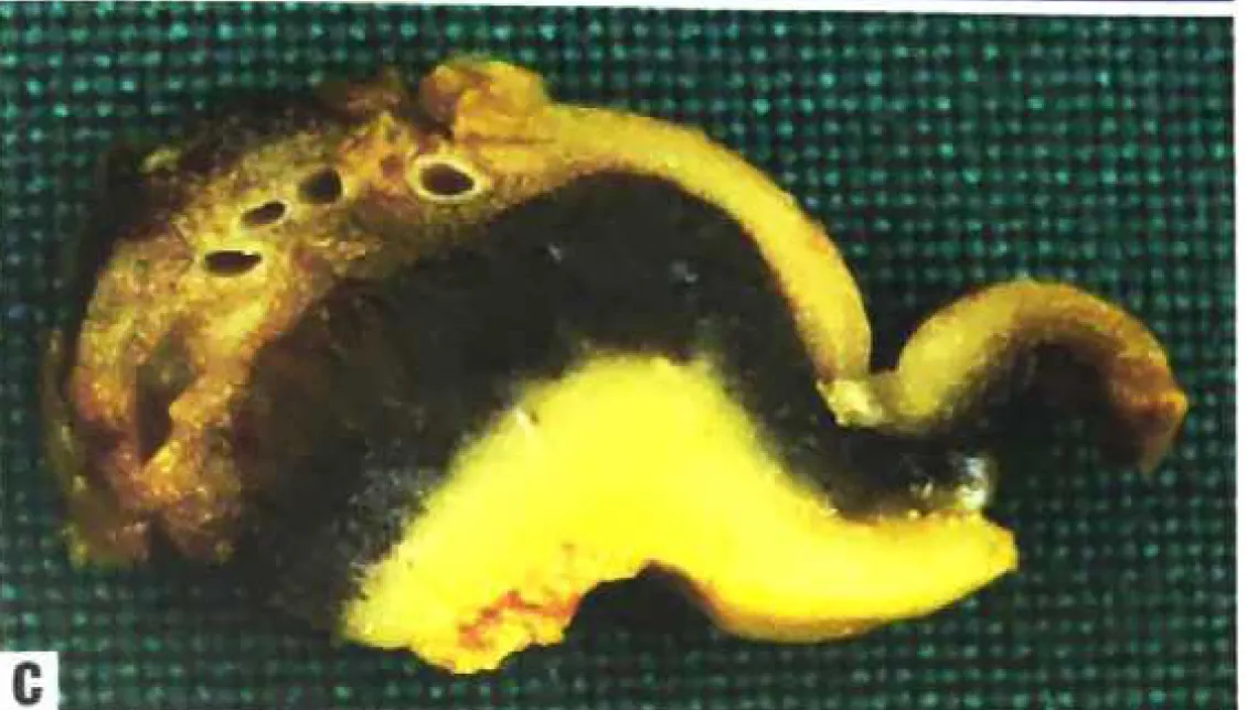 Meningeal melanomatosis. 
C Macroscopic appearance of the cerebral tissue shows brownish discolouration of the thickened leptomeninges and black discolouration of the underlying cerebral cortex.