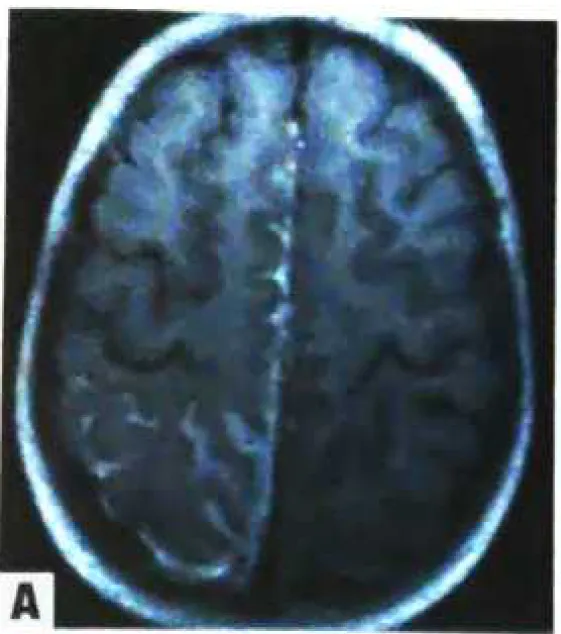 Meningeal melanomatosis. 
A T1-weighted axial MRI revealing a hyperintense, contrast-enhancing lesion outlining the gyri and sulci in the left fronto-parieto-occipital region in a 5-year-old child.