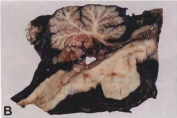 Fig. 12.01 A Meningeal melanocytosis involving the subarachnoid space of the cerebral hemispheres. B Meningeal melanomatosis infiltrating the meninges around the brain stem and cerebellum. 