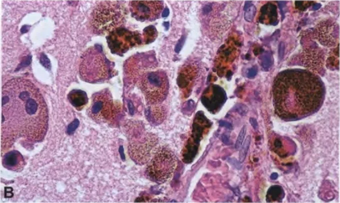 Fig. 12.02 Meningeal melanomatosis. A Extensive invasion of the subarachnoid space with perivascular infiltration of cerebral cortex. B Highly pleomorphic melanin-laden cells invading the cerebral cortex 