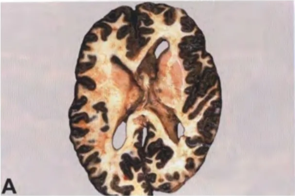 Fig. 12.01 A Meningeal melanocytosis involving the subarachnoid space of the cerebral hemispheres. B Meningeal melanomatosis infiltrating the meninges around the brain stem and cerebellum. 