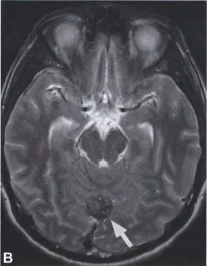 ig. 12.03 MRI features Of meningeal melanocytoma. A Tl-weighted axial images (pre-contrast) reveal a hyperintense, well-circumscribed mass in the midline Of the cerebellum rising from the dura. B On T2-weighted images, the mass is hypointense. C Following the administration Of contrast agent, the melanocytoma shows homogeneous enhancement. 
