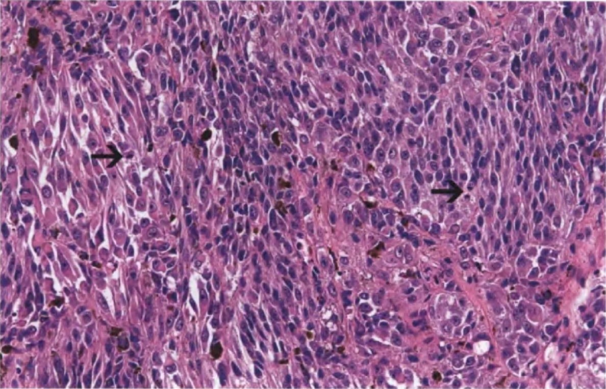 Fig. 12.06 Thoracic meningeal melanoma. The epithelioid and spindled tumour cells have ample, eosinophilic cytoplasm and a large vesicular nucleus with prominent nucleolus, and show marked mitotic activity (arrows). Dispersed melanophages are present between the tumour cells; in this tumour, a GNAII mutation was identified. 