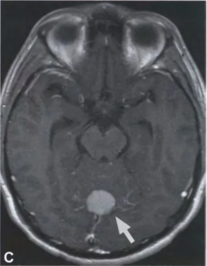 ig. 12.03 MRI features Of meningeal melanocytoma. A Tl-weighted axial images (pre-contrast) reveal a hyperintense, well-circumscribed mass in the midline Of the cerebellum rising from the dura. B On T2-weighted images, the mass is hypointense. C Following the administration Of contrast agent, the melanocytoma shows homogeneous enhancement. 