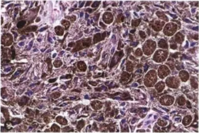 Fig. 12.04 Meningeal melanocytoma. A Loose or tight nests Of low-grade, pigmented spindle cells with intervening stroma containing higher levels Of melanin pigment. Note the vague, loosely formed whorls and fascicles. B Accumulation Of large, melanin-containing macrophages (melanophages) seen between turnour cells with a more spindled phenotype. The nuclei of tumour cells are bean-shaped and have micronucleoli. Melanin within the cytoplasm Of melanophages is typical in larger aggregates. C Melanin-containing macrophages (melanophages). 