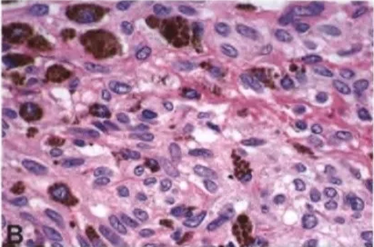 Fig. 12.04 Meningeal melanocytoma. A Loose or tight nests Of low-grade, pigmented spindle cells with intervening stroma containing higher levels Of melanin pigment. Note the vague, loosely formed whorls and fascicles. B Accumulation Of large, melanin-containing macrophages (melanophages) seen between turnour cells with a more spindled phenotype. The nuclei of tumour cells are bean-shaped and have micronucleoli. Melanin within the cytoplasm Of melanophages is typical in larger aggregates. C Melanin-containing macrophages (melanophages). 